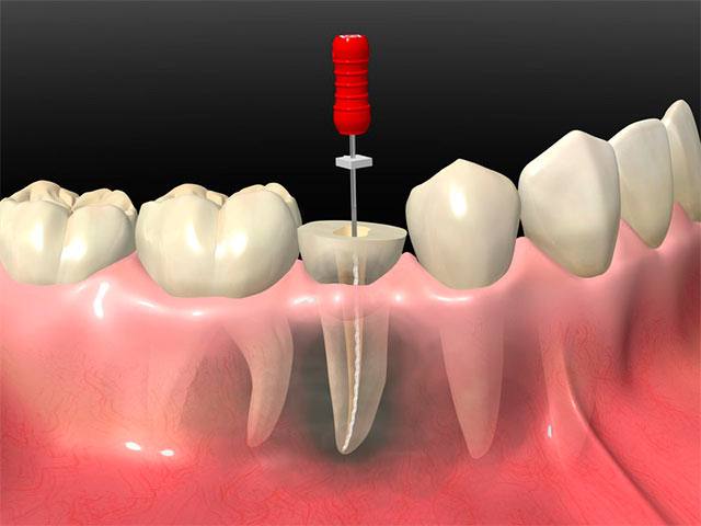 imagen de endodoncia clinica dental madrid