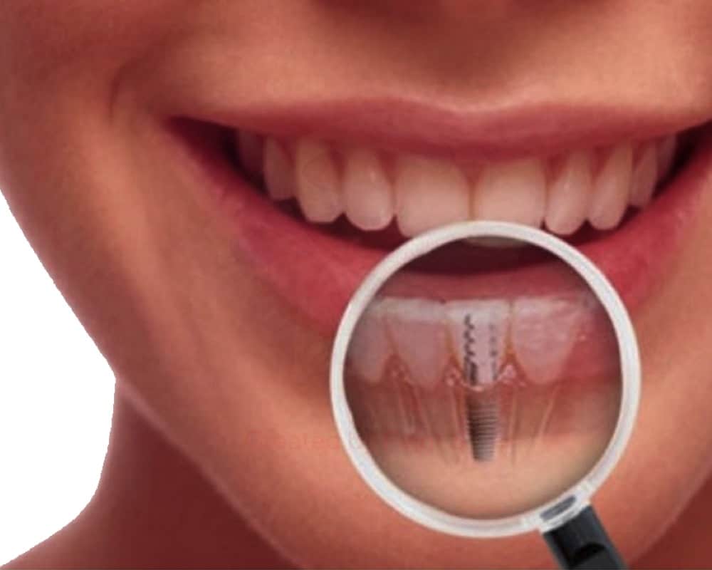 imagen de implantes dentales clinica moratalaz 66