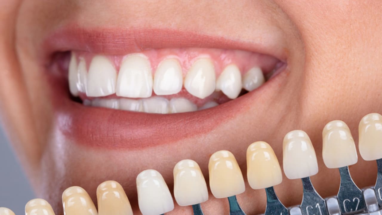 imagen de estetica dental carillas clinica dental madrid