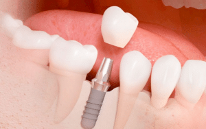imagen de implantes dentales garrucha odontostetic