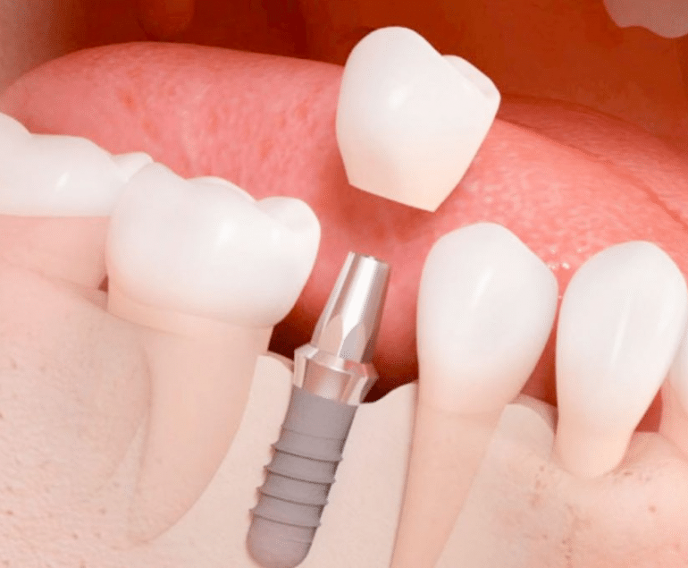 imagen de implantes dentales garrucha odontostetic