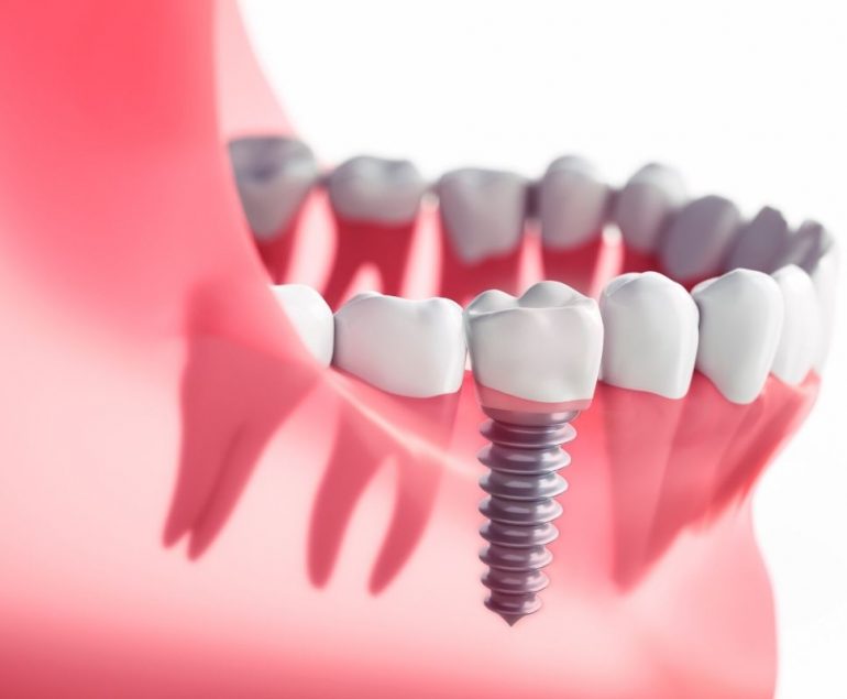 imagen de Implantes dentales o puentes dentales clinica dental en garrucha y los gallardos