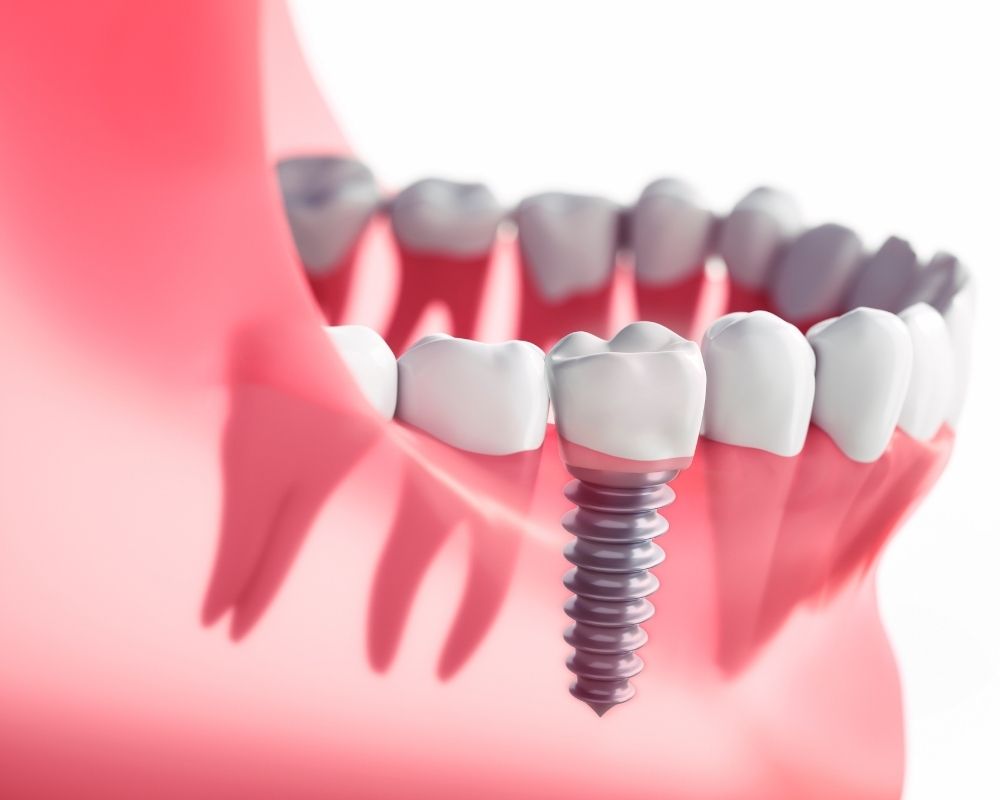 imagen de Implantes dentales o puentes dentales clinica dental en garrucha y los gallardos